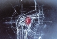 tendinite de l'épaule et ondes de choc