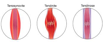 tendinite et kiné à 1190 bruxelles forest